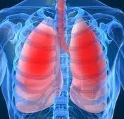 Болезнь легионеров