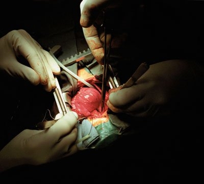 Атрезия легочной артерии