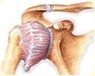Адгезивный капсулит плеча