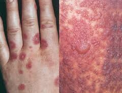 Буллезная многоформная эритема