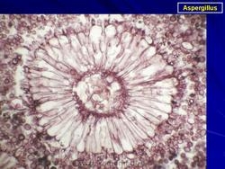 Инвазивный легочный аспергиллез