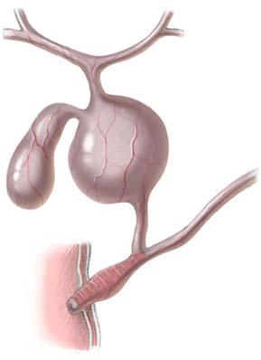 Киста холедоха