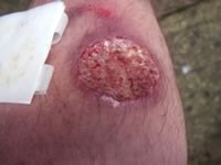 Болезнь Боровского