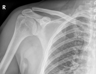 AC (Acromium ключицы) совместное разделение фото