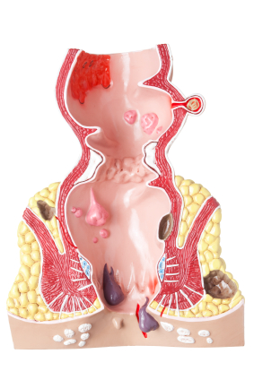 Аноректальные (периректальный) абсцесс фото