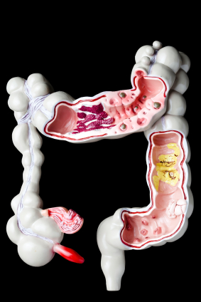 Аппендицит фото