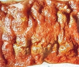 дизентерия фото, амебиаз описание болезни, амебная дизентерия признаки и причины заболевания