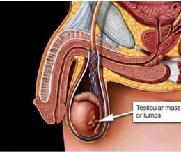 рак яичка фото, рак описание болезни, cancer признаки и причины заболевания