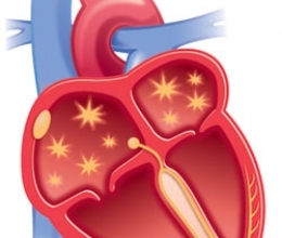 мерцательная аритмия фото, аритмия межжелудочковая описание болезни, мерцательная аритмия признаки и причины заболевания