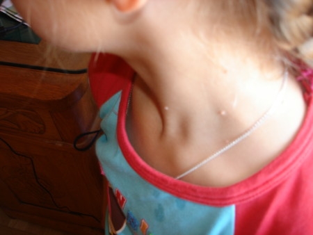 Контагиозный моллюск