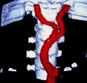 Аортоартериит