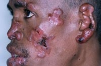 Лейшманиоз