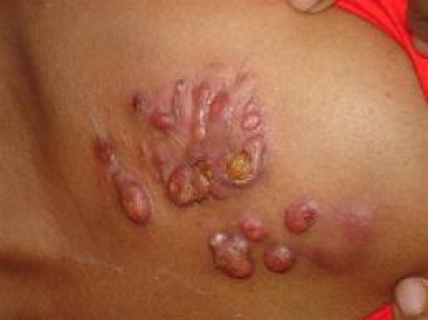 Актиномикоз