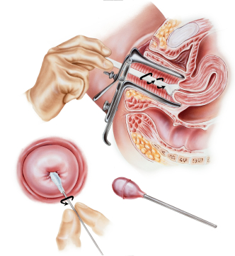 Цервицит (воспаление женских половых органов) фото