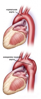 Аневризма грудной аорты