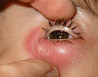 Дакриоцистит