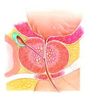 Аденома простаты