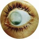 Бельмо роговицы (Лейкома)