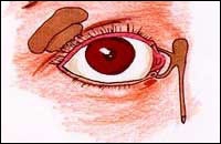 Болезни слезного аппарата