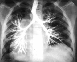 Бронхоэктазы у детей