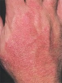 Контактный дерматит