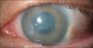 Буллезная кератопатия