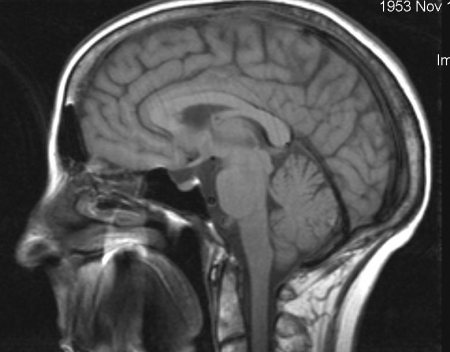 Гипертрофический узловатый глиоз