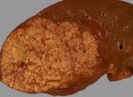 Амебный абсцесс печени