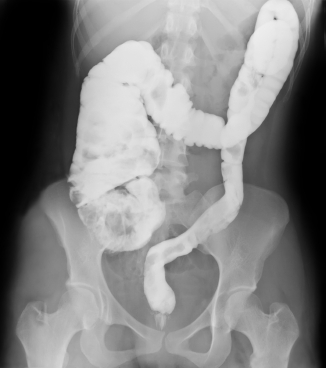 Кишечные заворот кишок (Скручивание кишечника) фото