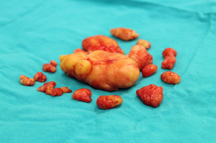 Липома (жирные опухоли) фото