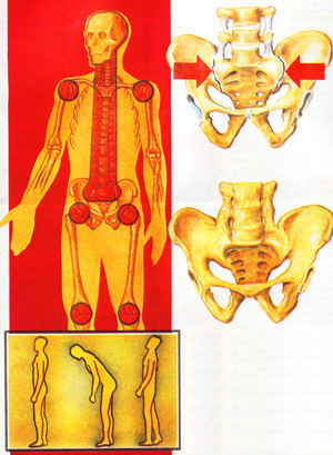 Болезнь Бехтерева ( анкилозирующий спондилоартрит)