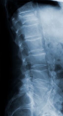 Остеопороз фото