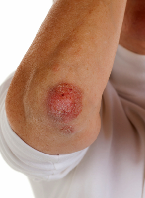 Псориаз фото