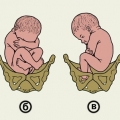 Предлежания плода головные неправильные