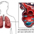 Отёк лёгких
