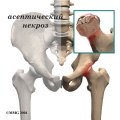 Асептический некроз головки бедренной кости