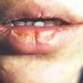 Болезни губ