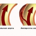 Расслаивающаяся аневризма аорты