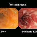 Болезнь Крона (воспаление кишечника)