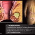 Аноректальный (периректальный) абсцесс