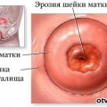 Эрозия шейки матки (истинная)