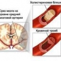 Атеросклероз сосудов головного мозга