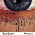 Блефарит