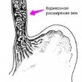 Варикозное расширение вен пищевода с кровотечением