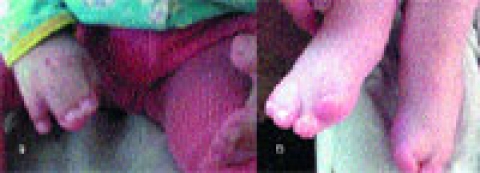 Синдром Апера