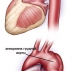 Аневризма грудной аорты