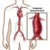 Аневризма брюшной аорты