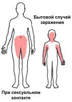 области заражения контагиозным моллюском в различных случаях