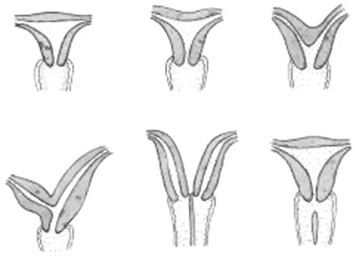 uterine_abnormalities