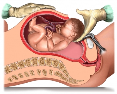 cesarean_delivery